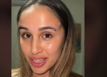 Cirurgia plástica dá erro e jovem surge com par de chifres na testa