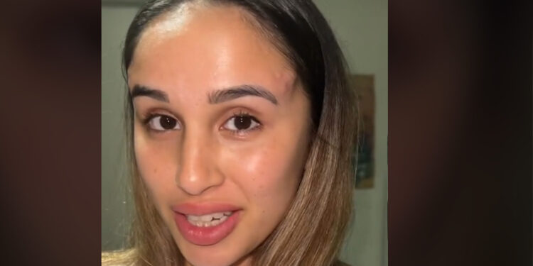 Cirurgia plástica dá erro e jovem surge com par de chifres na testa