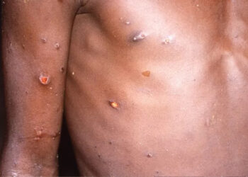 Argentina registra primeiro caso suspeito da varíola do macaco