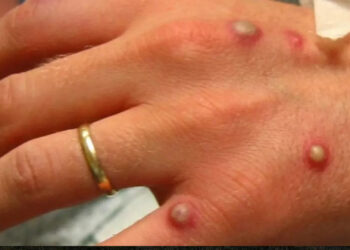 Varíola dos macacos: Anvisa pede uso de máscaras para retardar entrada do vírus