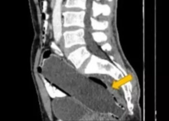 Após três dias de dor, mulher descobre que marido tinha garrafa no ânus