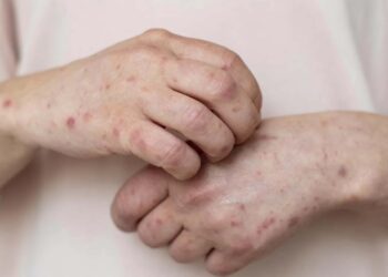 Secretaria da Saúde confirma transmissão comunitária da varíola dos macacos no RS