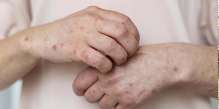 Secretaria da Saúde confirma transmissão comunitária da varíola dos macacos no RS