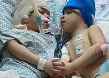 Gêmeos siameses unidos pela cabeça são separados em cirurgia inédita no SUS