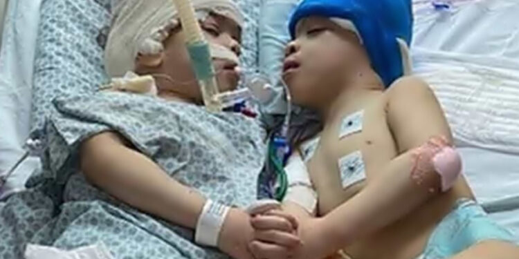 Gêmeos siameses unidos pela cabeça são separados em cirurgia inédita no SUS