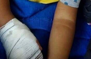 Bebê tem dedo amputado durante retirada de atadura em hospital no Rio de Janeiro