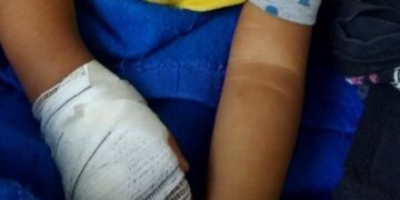 Bebê tem dedo amputado durante retirada de atadura em hospital no Rio de Janeiro