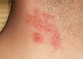 Herpes Zoster: Doença semelhante a catapora tem aumento de casos