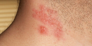Herpes Zoster: Doença semelhante a catapora tem aumento de casos