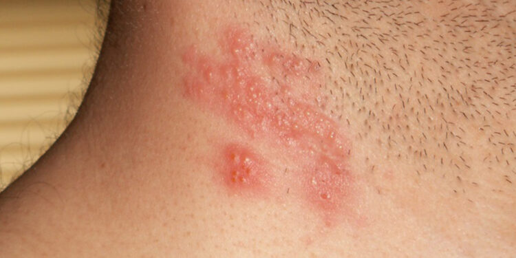 Herpes Zoster: Doença semelhante a catapora tem aumento de casos