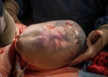 Mulher de 43 anos tem gêmeos e um dos bebês nasce empelicado, em Salvador