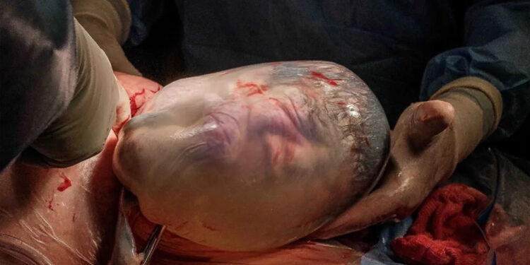 Mulher de 43 anos tem gêmeos e um dos bebês nasce empelicado, em Salvador