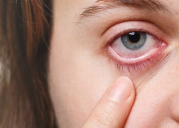 Arcturus: conjuntivite e febre alta são sintomas de nova variante da Covid-19