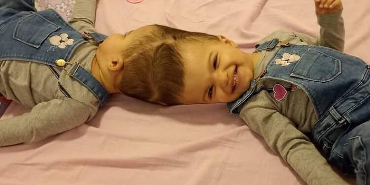 Gêmeas unidas pela cabeça são separadas após 25 horas de cirurgias em São Paulo