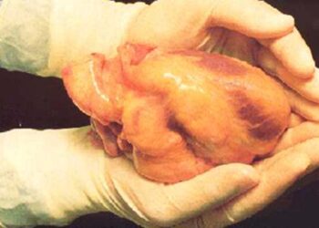 Conheça o único país que permite a venda de órgãos humanos