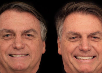 Bolsonaro gasta mais de R$ 80 mil em harmonização facial e dentária
