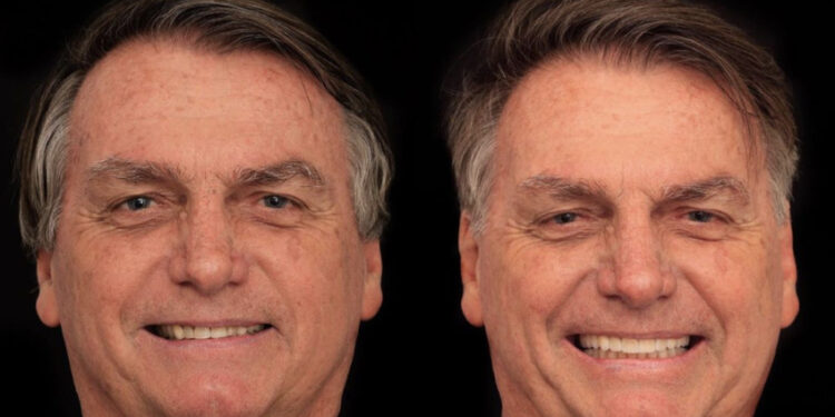 Bolsonaro gasta mais de R$ 80 mil em harmonização facial e dentária