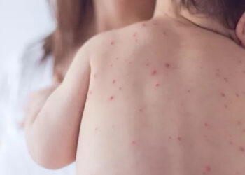 Rio Grande do Sul confirma caso importado de sarampo e reforça recomendação de vacina contra a doença