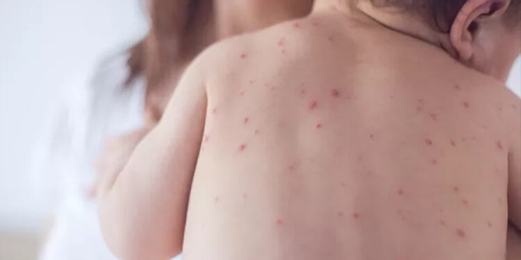 Rio Grande do Sul confirma caso importado de sarampo e reforça recomendação de vacina contra a doença