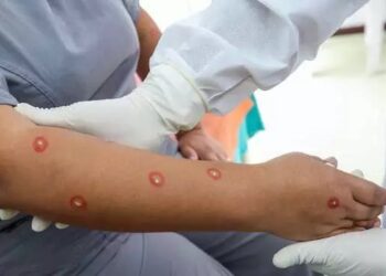 Saúde “Mpox não é a nova Covid”, diz diretor da Organização Mundial da Saúde