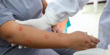 Saúde “Mpox não é a nova Covid”, diz diretor da Organização Mundial da Saúde