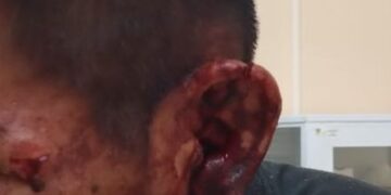Homem é esfaqueado na orelha e no rosto em Briga na Linha Salete Interior de Nova Roma Do Sul