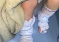 Bebê de 11 meses tem queimaduras de 2º grau após banho em escola no RS