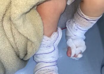 Bebê de 11 meses tem queimaduras de 2º grau após banho em escola no RS