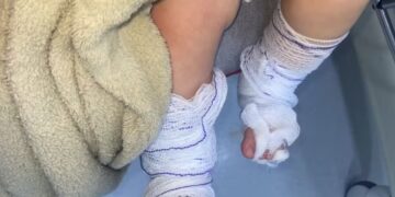 Bebê de 11 meses tem queimaduras de 2º grau após banho em escola no RS